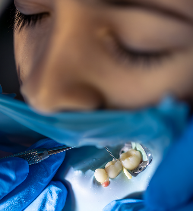 Best Dental Crowns Treatment in Indore