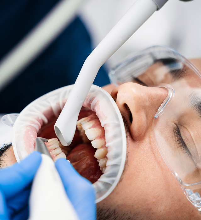 Teeth Cleaning and Polishing in Indore