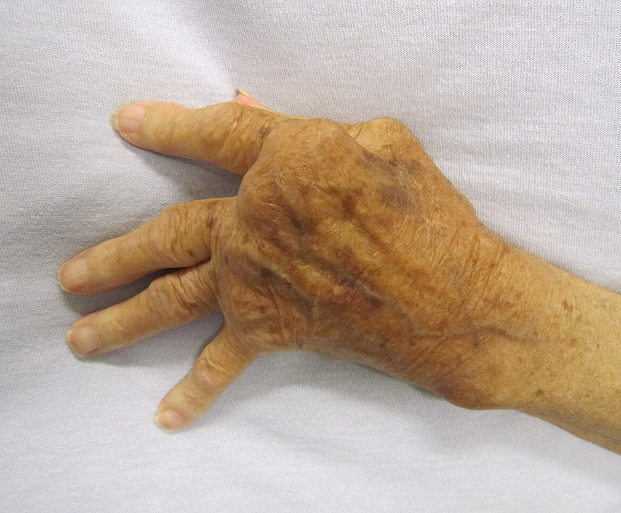 Arthritis Treatment in Indore