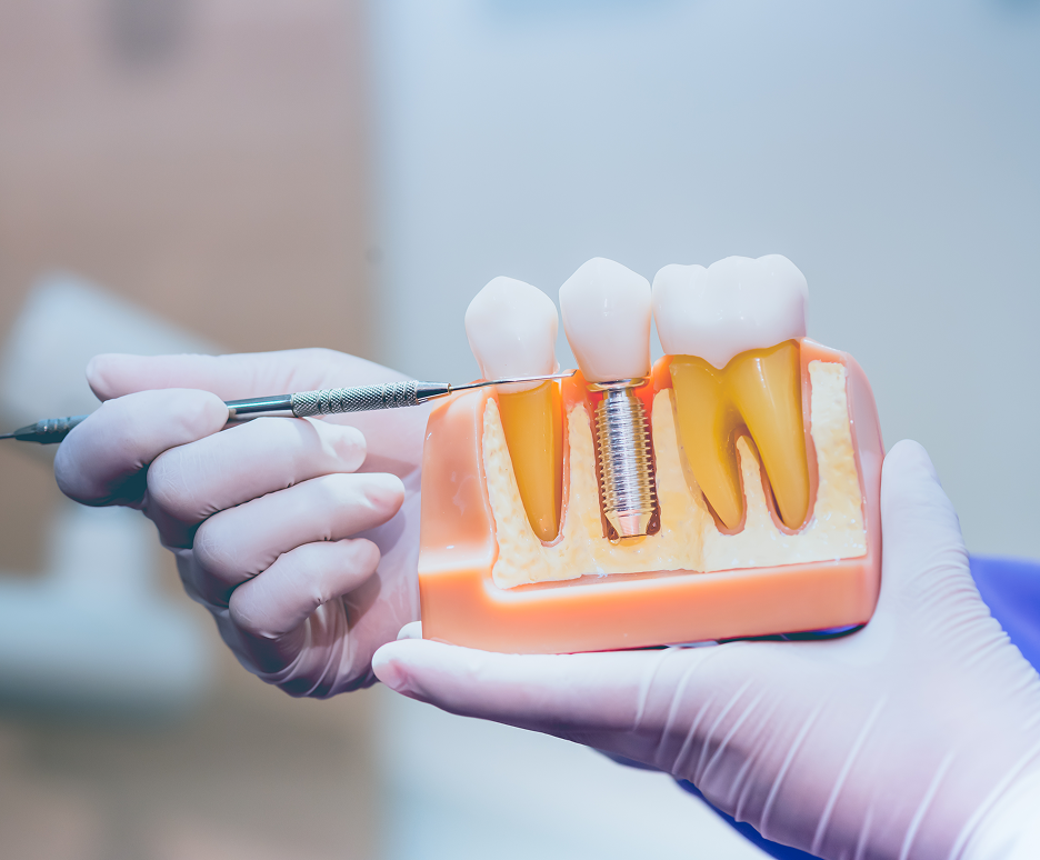 Dental Implants Treatment in Indore